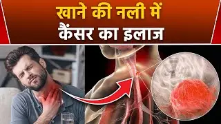 Esophageal Cancer Treatment: Food Pipe Cancer Treatment In Hindi | Khane Ki Nali Me Cancer Ka Ilaj