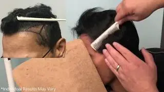 Dense packing Hair Transplant Results in Los Angeles - Hair Restoration in Los Angeles