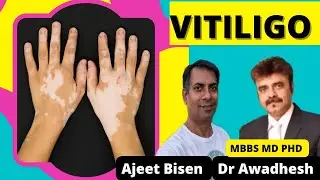 सफ़ेद दाग/VITILIGO👩‍🦳 का प्राकृतिक इलाज🌿: DR AWADHESH PANDEY#ajeetbisen