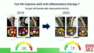 Sponsored Sym | Visualising Coronary Inflammation in CCTA: The Next Frontier for CV Risk Prediction