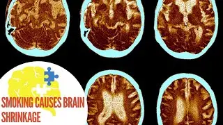 Smoking causes brain shrinkage - Health News | Global Health | Medical Breakthrough