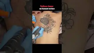 100% Tattoo Removal Possible? Watch This!