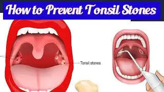 How to Prevent Tonsil Stones Naturally | Best Tips for Fresh Breath & Healthy Tonsils!