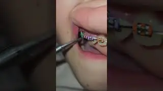 St. Patrick's Day braces colors HACK!