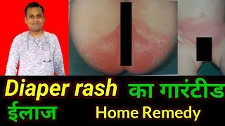 Diaper Rash Treatment