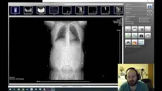 My Recent CAT Scan, Please Review With Me, Feeling Of Fluid Moving