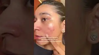 5 Signs your Skin Barrier is damaged ✅ #short #skinbarrier #skincare