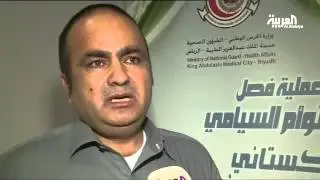 نجاح عملية فصل التوأم السيامي الباكستاني في السعودية