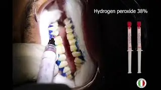 The Smile Strong 38% - dental office bleaching - كيت تبييض الاسنان 38% طريقة الاستخدام .(حالة عملية)