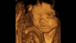 Ultrasound compilation
