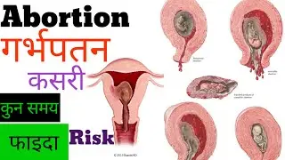 गर्भपतन || abortion || कसरी गरिन्छ || सावधानी || Risk in nepali 