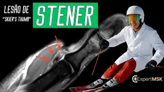 Lesão de STENER do polegar (Polegar do Esquiador)