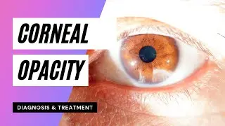 Corneal Opacity | Eye Disease | Treatment