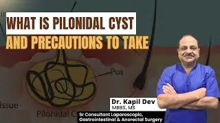What is Pilonidal Cyst and What to Do If It Occurs? | Dr. Kapil Dev