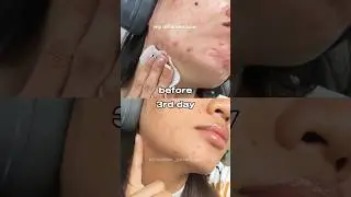 I tried the Pcalm toner pads and my acne prone skin loved it! 🥰 #acnetreatment #toner #skincare