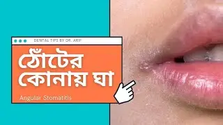ঠোটের কোনায় ঘা Angular Stomatitis