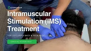 Intramuscular Stimulation IMS treatment on Left Upper Back and Neck Muscles