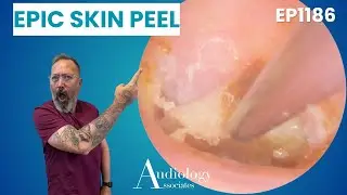 Satisfying Eardrum Peel &ndash; You Won&rsquo;t Believe This! - EP1186