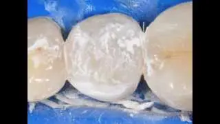 SonicFill and Vertise Flow posterior resin composite restoration.