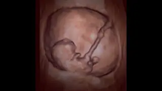 HEMATOMA SUBCORIÔNICO - DESCOLAMENTO DE PLACENTA - SANGRAMENTO NO INÍCIO DA GESTAÇÃO - SARRAFF SAÚDE