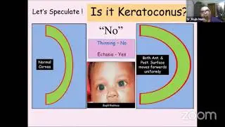 Dr  Rajib Mukherjee   Posterior Corneal Elevation What&rsquo;s the true picture