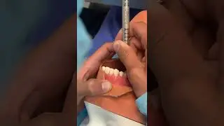 Cara vestibular pieza 1.4