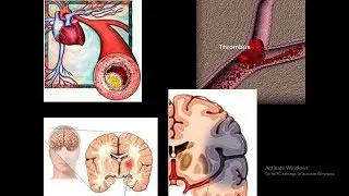 Diagnosis and Management of Acute Stroke