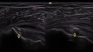 Multifactorial shoulder pain &ndash; Supraspinatus tear, Subscapularis calcific tendinitis and Bursitis.
