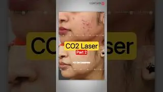 CO2 Laser Acne Scar Treatment: Transform Your Skin in Just One Session! | Clear Skin Clinic