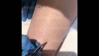 DL900  Diode  Laser Hair Removal Feedback