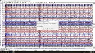 fMRI EEG Pulse Artifact Correction In BESA Research