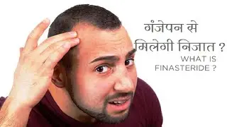गंजेपन का इलाज hair baldness treatment @MEDICINEVISION