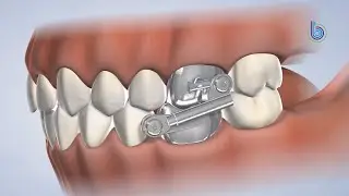 Herbst Appliance Instructions in Omaha NE | Braces Omaha