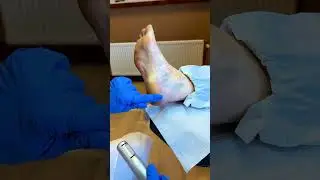 Hoe je de Omnicut 2.0 Gebruikt🤔 #omnicut #callusremoval #footcare