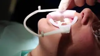 Installing braces, BRACES EXPERTS MICHIGAN, ROCHESTER HILLS