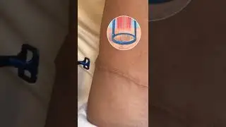 Tummy Tuck Scar Treatment Using the Pixel Laser ⚡️