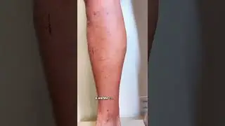 5 dias ap&oacute;s o tratamento dessas varizes grossas #varizes #laser #varizesnuncamais