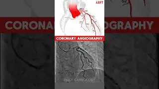 Coronary Angiography #angiography #shorts #cardiology #hearthealth