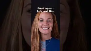 Life Changing All-on-4 Dental Implants | All-on-X Before and After