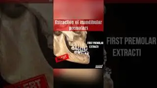 EXTRACTION OF MANDIBULAR PREMOLARS - ORTHODONTIC TIPS #Shorts