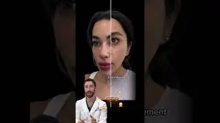 Почему результаты на одних участках кожи выглядят более гармоничными, чем на других? #филлеры #ла...