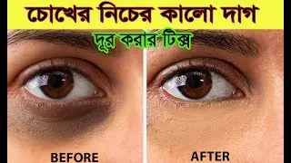 Remove dark circles under eyes naturally #technology