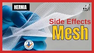 Hernia mesh side effects explained by doctor in hindi