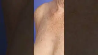 Sun Damage Treatment!