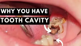 What Makes You Prone To TOOTH DECAY AND CAVITIES & How To PREVENT It.
