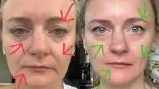 Easy face yoga Exercise To Get a Natural Face Lift Faceyoga#Skincare#antiaging #faceyoga #smilelines