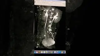 CT urography / contrast ct scan | ct kub #video #trending #viral #ctscan #mip #kub #urography