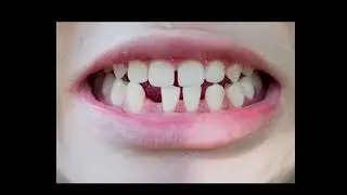 Human Tooth Regeneration-2025 Breakthrough Junior Challenge