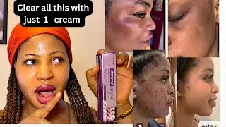 Cheapest product that treat eczema acne rough face hyperpigmentation sunburn and redness in few days