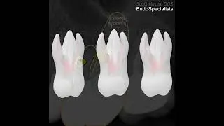Why Does a Root Canal Need to Be Redone? | Dr. Hirose Explains Retreatment 